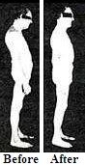 ROLFING BEFORE AND AFTER PHOTO #2